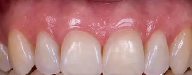 Antes: dentes superiores com tons desiguais