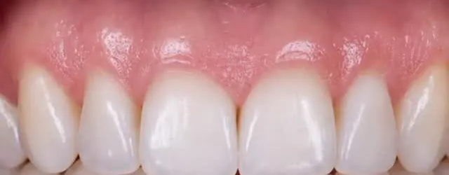 Depois: dentes superiores com cor uniforme e clara